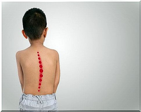 Scoliosis