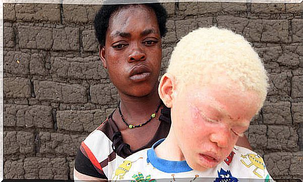 child with albinism