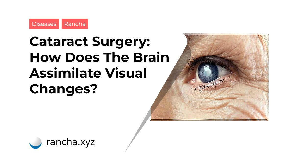 Cataract Surgery: How Does The Brain Assimilate Visual Changes?